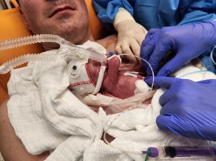 "Zero Separation" in der Neonatologie. Hautnah ins Leben starten